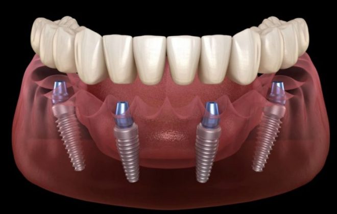 all on 4 dental implant marketing sydney melbourne brisbane all on four plus