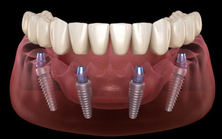 all on 4 dental implant marketing sydney melbourne brisbane all on four plus